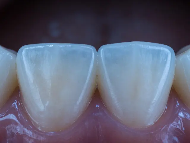 Jak bezpečná je bělící zubní pasta pro vaše zuby? - Skutečné rizika a jak se chránit