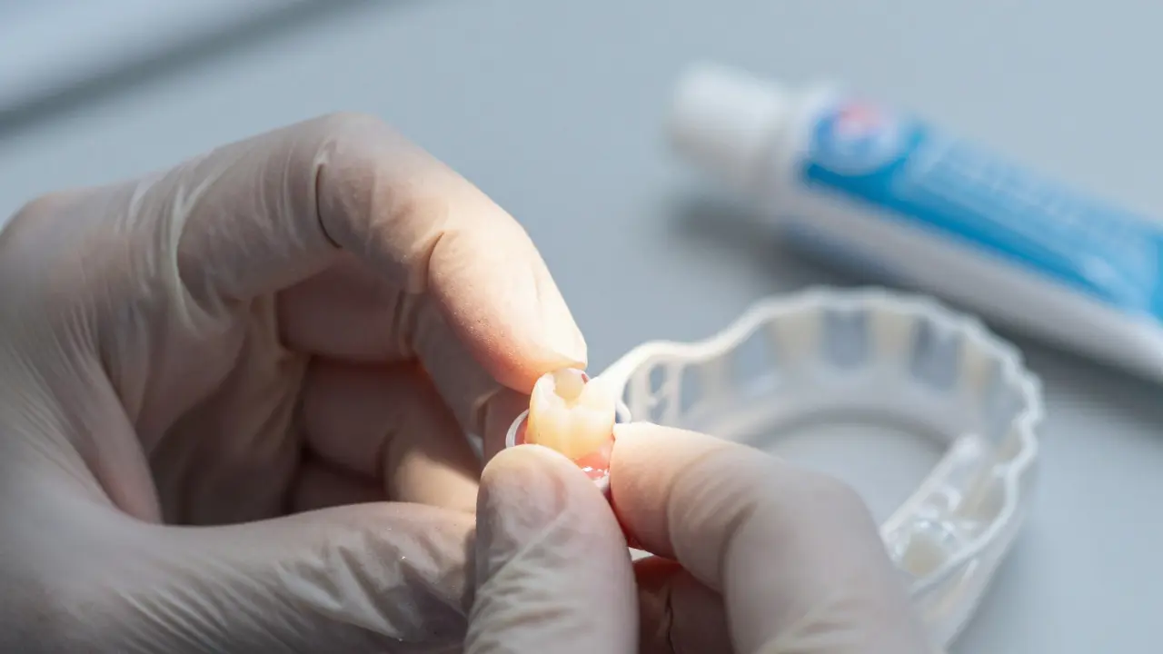 Zubní lékař opravuje průhledný zub kompozitní plombou na hraně.