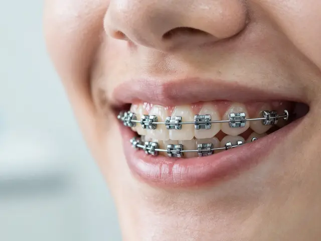 Co očekávat od nošení rovnátek: Komplexní průvodce pro začátečníky