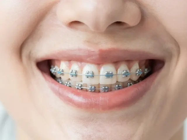 Keramická rovnátka: Estetická cesta k rovným zubům a zdravému úsměvu