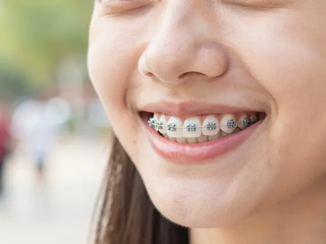 Keramické rovnátka pro teenager: Kompletní průvodce cenami, péčí a výběrem